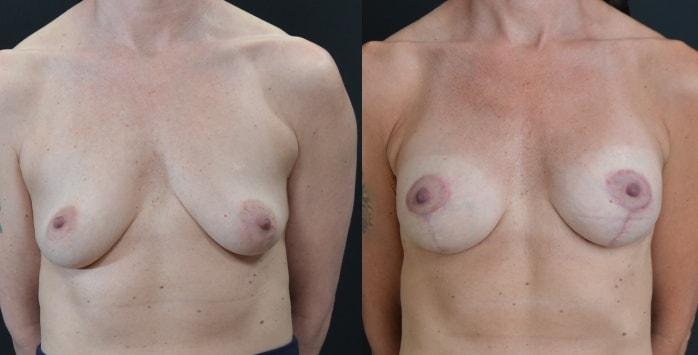 Hetal Fichadia, MD, FACS breast augmentation result — Portland, OR