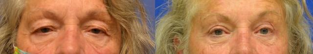 Brow Lift result at Hetal Fichadia, MD, FACS in Portland, OR