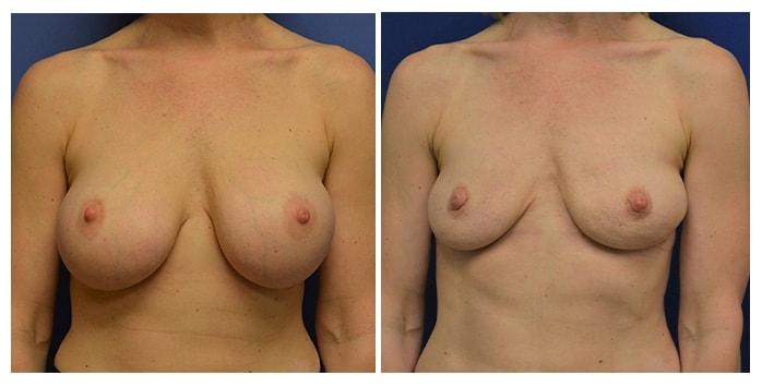 Hetal Fichadia, MD, FACS breast implant removal result — Portland, OR