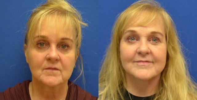 Neck Lift result at Hetal Fichadia, MD, FACS in Portland, OR