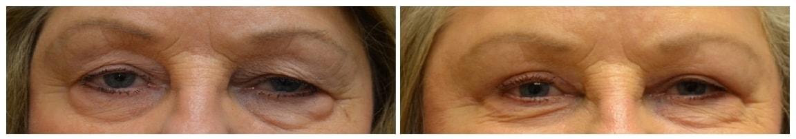 Hetal Fichadia, MD, FACS eyelid lift result — Portland, OR