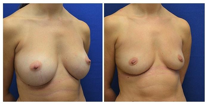 Hetal Fichadia, MD, FACS breast implant removal result — Portland, OR