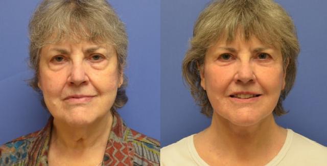 Neck Lift result at Hetal Fichadia, MD, FACS in Portland, OR