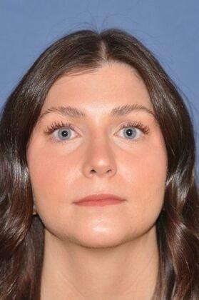 The Clinic of Facial Plastic Surgery rhinoplasty after — Buffalo, NY