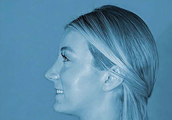 Rhinoplasty after at The Clinic of Facial Plastic Surgery in Buffalo, NY