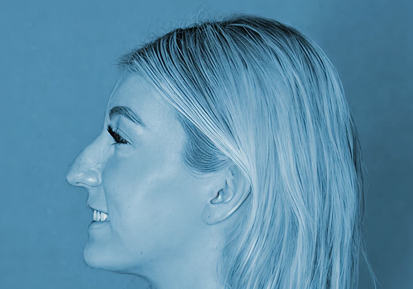 Rhinoplasty before at The Clinic of Facial Plastic Surgery in Buffalo, NY