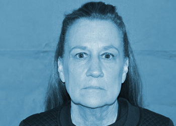 Facelift before at The Clinic of Facial Plastic Surgery in Buffalo, NY