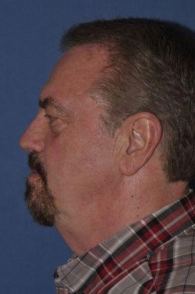 Deep Plane Facelift before at The Clinic of Facial Plastic Surgery in Buffalo, NY