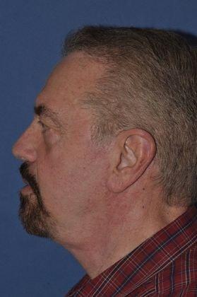 Deep Plane Facelift after at The Clinic of Facial Plastic Surgery in Buffalo, NY