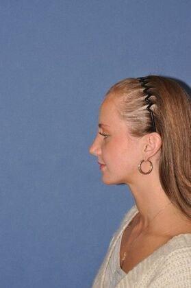 The Clinic of Facial Plastic Surgery rhinoplasty after — Buffalo, NY