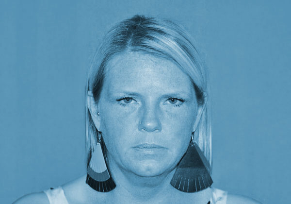 Deep Plane Facelift before at The Clinic of Facial Plastic Surgery in Buffalo, NY