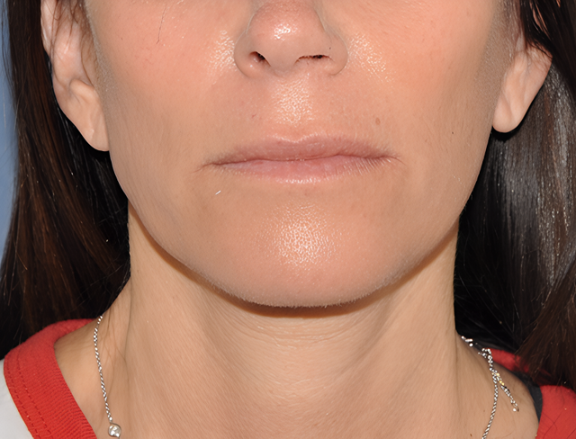 Facelift after at The Clinic of Facial Plastic Surgery in Buffalo, NY