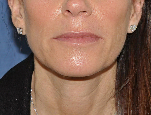 Facelift before at The Clinic of Facial Plastic Surgery in Buffalo, NY