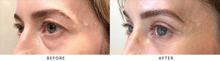 Christopher I. Zoumalan, MD brow lift result — Beverly Hills, CA