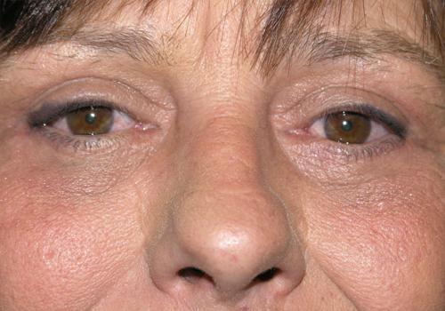 East Bay Aesthetic Surgery (Eric P. Bachelor, MD) eyelid lift after — Danville, CA