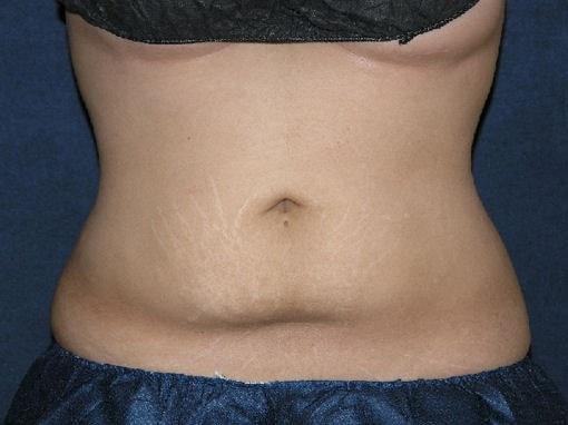East Bay Aesthetic Surgery (Eric P. Bachelor, MD) fat freezing after — Danville, CA