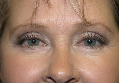East Bay Aesthetic Surgery (Eric P. Bachelor, MD) eyelid lift after — Danville, CA