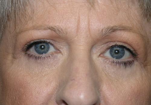 East Bay Aesthetic Surgery (Eric P. Bachelor, MD) eyelid lift after — Danville, CA