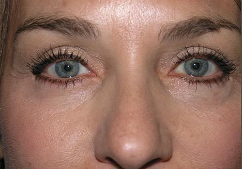East Bay Aesthetic Surgery (Eric P. Bachelor, MD) eyelid lift after — Danville, CA