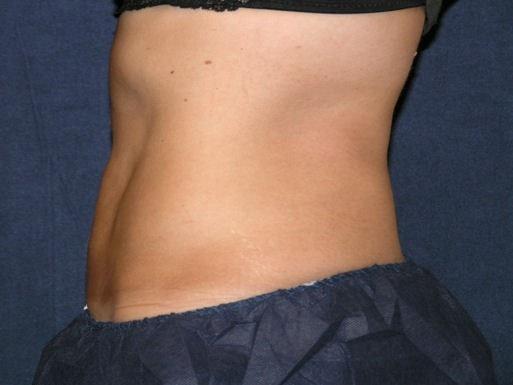 East Bay Aesthetic Surgery (Eric P. Bachelor, MD) fat freezing after — Danville, CA