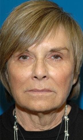 Deep Plane Facelift before at Naficy Plastic Surgery & Rejuvenation Center in Bellevue, WA