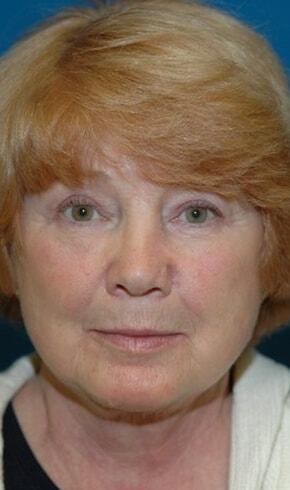 Naficy Plastic Surgery & Rejuvenation Center facelift after — Bellevue, WA
