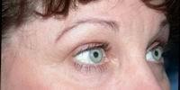Naficy Plastic Surgery & Rejuvenation Center eyelid lift after — Bellevue, WA