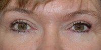 Naficy Plastic Surgery & Rejuvenation Center eyelid lift after — Bellevue, WA