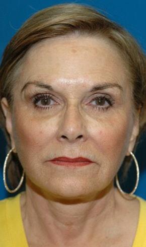 Naficy Plastic Surgery & Rejuvenation Center facelift after — Bellevue, WA