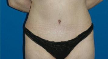 Naficy Plastic Surgery & Rejuvenation Center tummy tuck after — Bellevue, WA