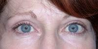 Naficy Plastic Surgery & Rejuvenation Center eyelid lift after — Bellevue, WA