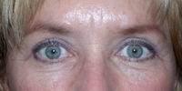 Naficy Plastic Surgery & Rejuvenation Center eyelid lift after — Bellevue, WA