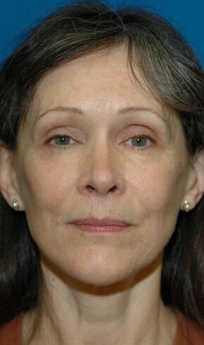 Naficy Plastic Surgery & Rejuvenation Center facelift after — Bellevue, WA