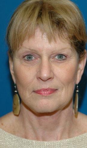 Naficy Plastic Surgery & Rejuvenation Center facelift after — Bellevue, WA