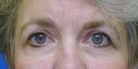 Naficy Plastic Surgery & Rejuvenation Center eyelid lift after — Bellevue, WA