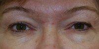 Blepharoplasty before at Naficy Plastic Surgery & Rejuvenation Center in Bellevue, WA