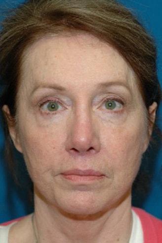 Naficy Plastic Surgery & Rejuvenation Center rhinoplasty after — Bellevue, WA