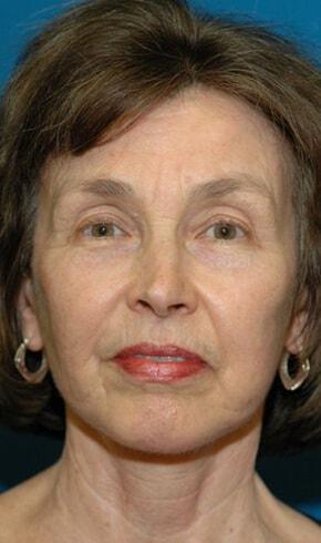 Naficy Plastic Surgery & Rejuvenation Center facelift after — Bellevue, WA