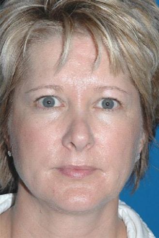 Rhinoplasty before at Naficy Plastic Surgery & Rejuvenation Center in Bellevue, WA