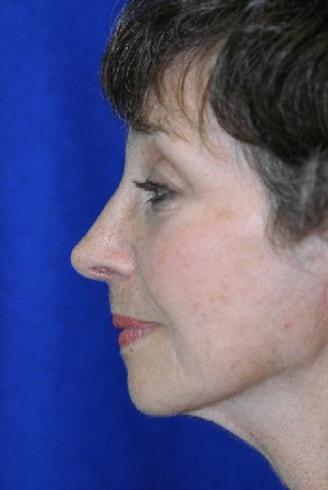 Naficy Plastic Surgery & Rejuvenation Center rhinoplasty after — Bellevue, WA