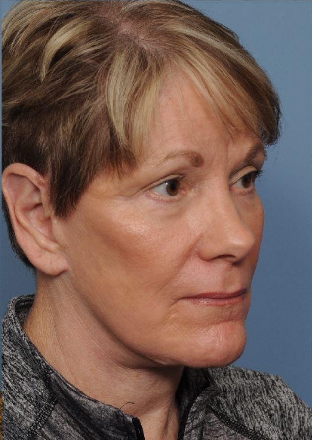 Deniz Gerecci, MD laser treatment after — Lake Oswego, OR