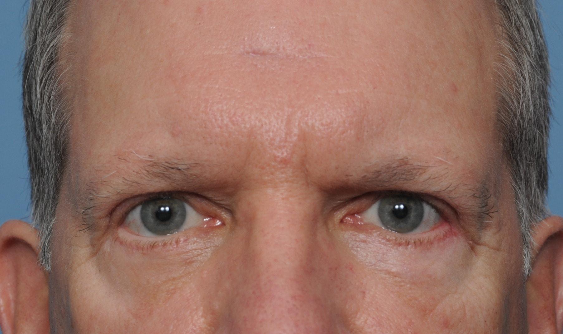 Deniz Gerecci, MD eyelid lift after — Lake Oswego, OR