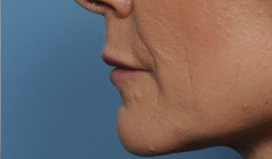 Deniz Gerecci, MD jawline filler after — Lake Oswego, OR