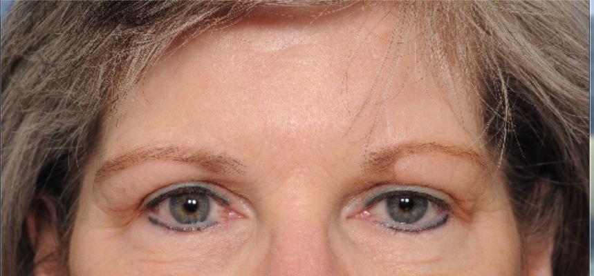 Deniz Gerecci, MD eyelid lift after — Lake Oswego, OR