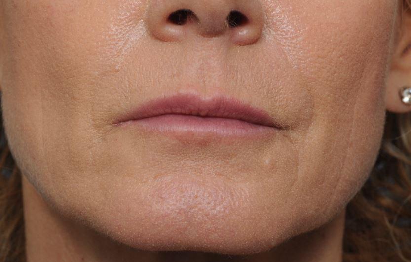 Deniz Gerecci, MD lip filler after — Lake Oswego, OR