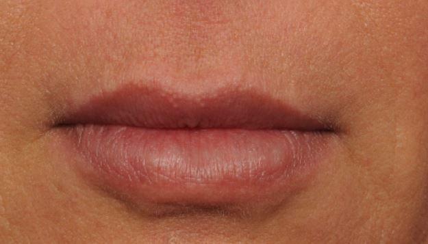 Deniz Gerecci, MD lip filler after — Lake Oswego, OR