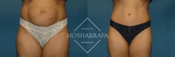 Mosharrafa Plastic Surgery tummy tuck result — Phoenix, AZ
