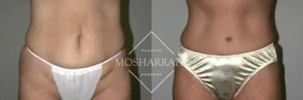 Mosharrafa Plastic Surgery tummy tuck result — Phoenix, AZ