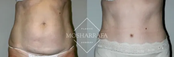 Mosharrafa Plastic Surgery tummy tuck result — Phoenix, AZ