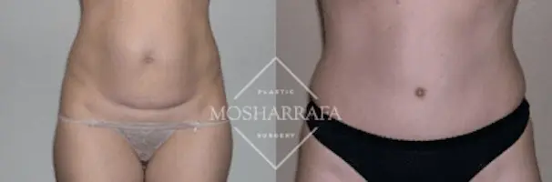 Mosharrafa Plastic Surgery tummy tuck result — Phoenix, AZ